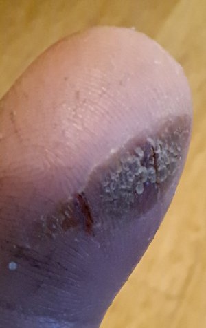 Burn Blister 4.JPG